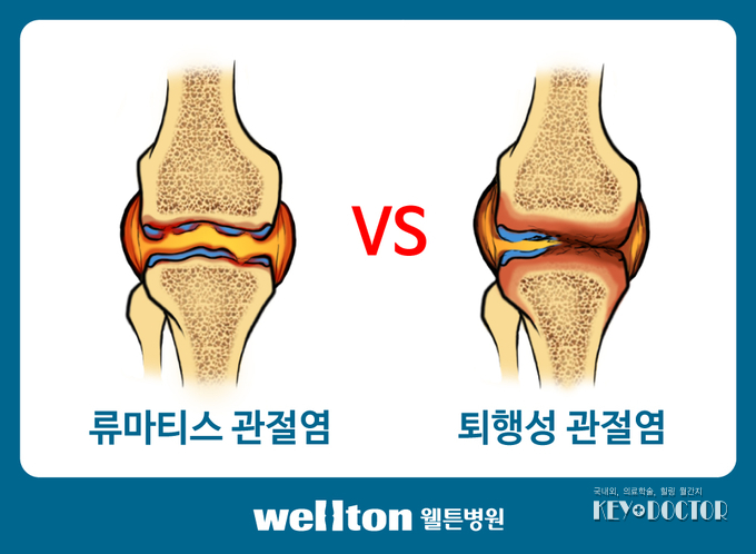 류마티스관절염vs퇴행성관절염